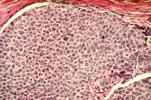 Microscopy of breast cancer cells