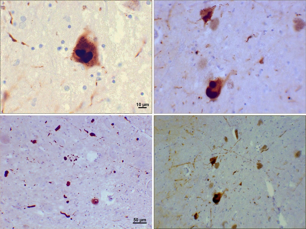 Microscopy of Lewy bodies (α-synuclein inclusions) in substantia nigra neurons from a Parkinson's brain